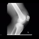 Fracture of patella, hematoma in suprapatellar recess: X-ray - Plain radiograph